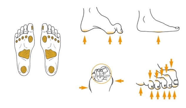 Areas of the foot at highest risk for ulceration