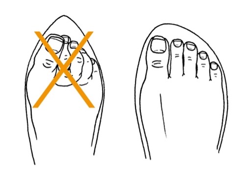 Footwear should be sufficiently wide to accommodate the foot without excessive pressure on the skin