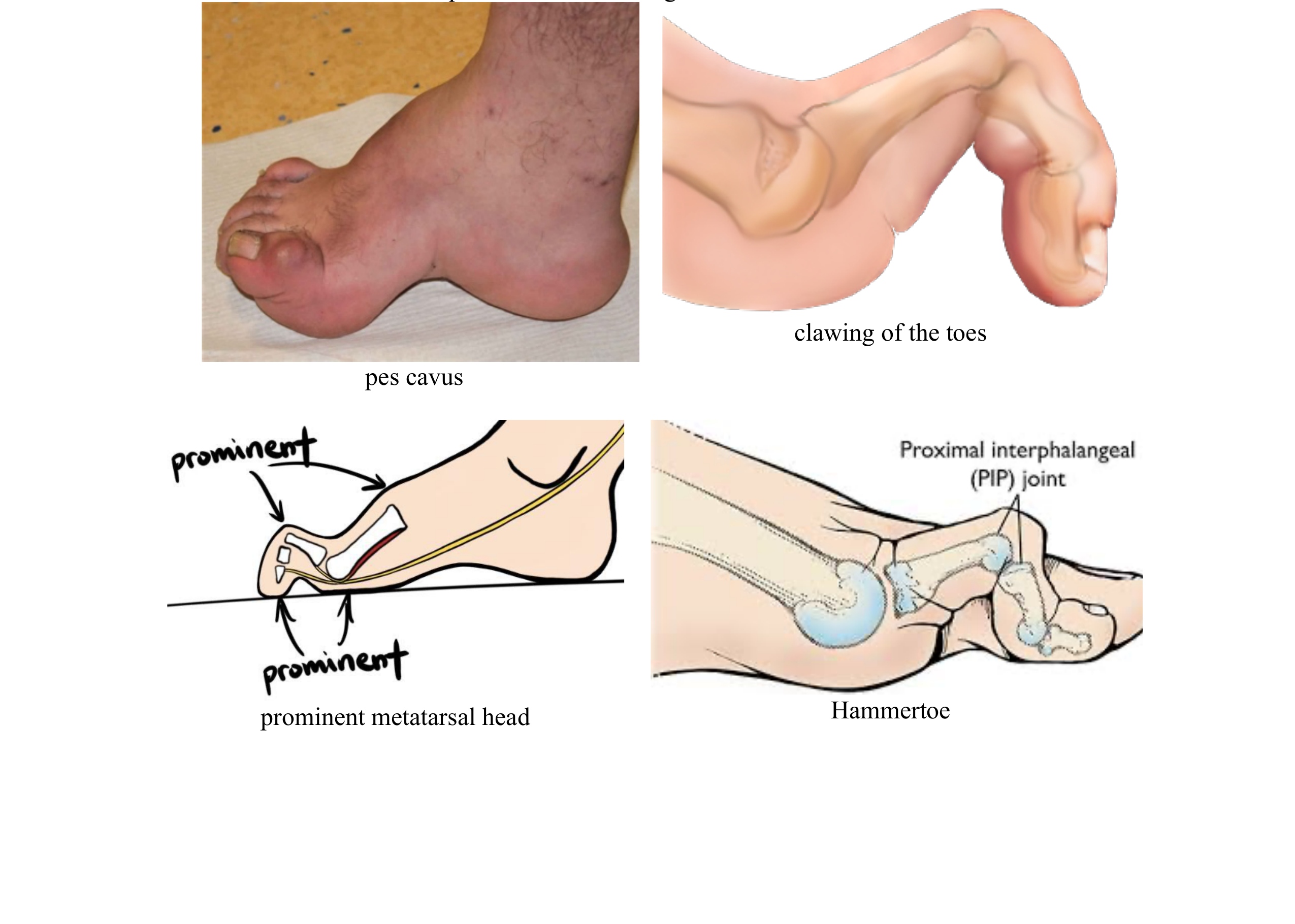 foot deformities with pes cavus and clawing of the toes