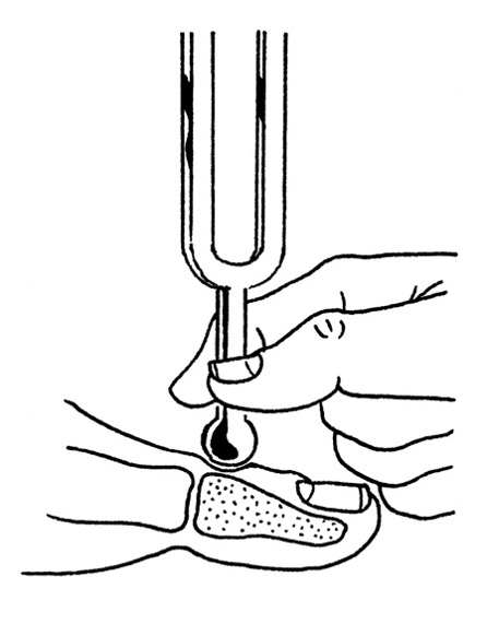 Vibration using 128 Hz tuning fork