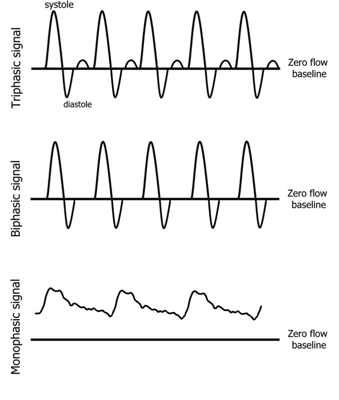 Ankle Pressure And Assessment Of The Doppler Waveform